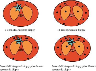 Efficacy and safety of the new biopsy strategy combining 6-core systematic and 3-core MRI-targeted biopsy in the detection of prostate cancer: Study protocol for a randomized controlled trial